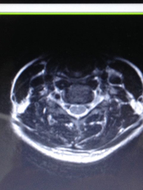 正常な頚椎のMRI横断面